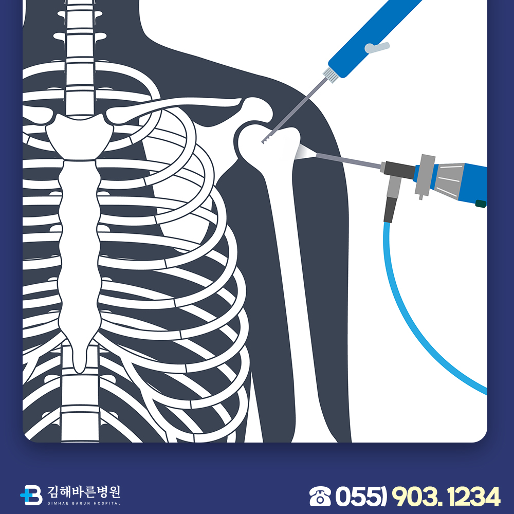 오십견 주사치료와 수술, 어떤 기준으로 결정될까?